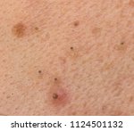 Small photo of Black dots on face and pimples macro, comedo