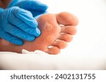 Small photo of A doctor examines the foot of a person who has a large callus and a stem wart. Treatment and removal of warts and corns.