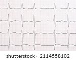 Small photo of Electrocardiogram with arrhythmia due to atrial fibrillation