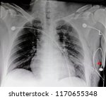 Small photo of Chest xray film of a patient with comminuted fracture of left clavicle, hemothorax, and subcutaneous emphysema (air leakage in subcutaneous tissue). A chest drain tube is also seen in the left lung.
