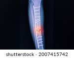 Small photo of X-ray film of a patient with comminuted fracture of right tibia after surgical fixation with metal plates and screws.