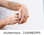 Hands With Vitiligo Skin...