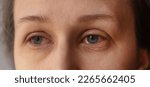Small photo of Women's eyes close-up. Disease affects the eyes, the conjunctiva swells, lacrimation and redness appear. Reaction to an allergen. Loss of vision, discharge of pus in bacterial conjunctivitis. Swelling