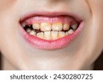 Small photo of Close up of unhealthy baby teeths. Open mouth of a little boy with improperly growing teeth close-up. The concept of orthodontic and stomatology. Bad teeth child. Portrait boy with bad teeth.