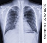 Small photo of Chest x-ray image , Normal Chest.