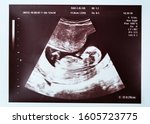 Small photo of Baby on ultrasound. An ultrasound scan of a baby in the womb. 20 weeks gestation.