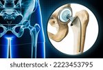 Femoral Head Hip Prosthesis Or...