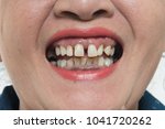 Close Up Ugly Woman Teeth Away