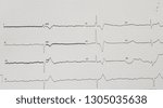 Small photo of Complete heart block with ventricular escape rhythm. Sinus rachycardia.