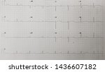Small photo of Complete heart block. 3rd degree AV block (nodal block).