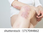Small photo of Acute psoriasis on the knees ,body ,elbows is an autoimmune incurable dermatological skin disease. Large red, inflamed, flaky rash on the knees. Joints affected by psoriatic arthritis.