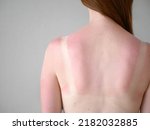 Small photo of Close-up view of sunburn marks woman's back. Woman with reddened itchy skin after sunburn.