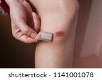 Small photo of Abrasion on the woman's knee. Girl is applying antiseptic band-aid plaster on the injured leg with a red wound. Medical treatment.