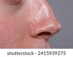 Small photo of Closeup view of woman with reddened skin on grey background