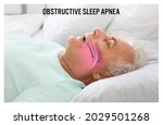 Small photo of Illustration showing airway during obstructive sleep apnea