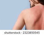 Small photo of Allergic young woman with sunburned skin on blue background, back view