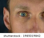 Small photo of Mens eyes obstructive Jaundice yellowish. Real people liver dysfunction icteruswith cirrhosis hepatitis symptom face skin. Young man bilirubin pigmentation biliary tract obstruction Gilbert's syndrome
