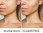 Small photo of Cropped shot of young woman's face before and after plastic surgery buccal fat pad removal. A lower part of face with clear highlighted cheekbones. Result of cosmetic surgery