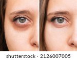 Small photo of Cropped shot of a young caucasian woman's face with dark circles under eyes before and after cosmetic treatment. Bruises under the eyes caused by fatigue, insomnia. The result of therapy