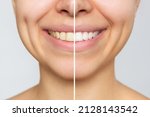 Small photo of Cropped shot of a young smiling woman before and after teeth whitening isolated on a gray background. Dark tooth enamel, contrast. Dentistry, dental care