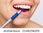 Small photo of Cropped shot of a young woman pointing to white spots on the tooth enamel with a pen. Oral hygiene, dental health care. Dentistry, demineralization of teeth, enamel hypoplasia, fluorosis