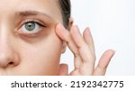 Small photo of A young caucasian woman demonstrating dark circles under her eyes with hand isolated on a white background. Pale skin, bruises under the eyes are caused by fatigue, lack of sleep, insomnia and stress