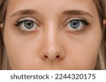 Small photo of Cropped shot of a young woman's face with with eyes of different colors: green and blue. Close up of lenses of various colors. Sectoral heterochromia, a genetic trait