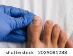 A doctor examines bare foot with onycholysis on a toenail after damaging with tight shoes or using gel-lacquer