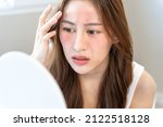 Small photo of Young woman asian are worried about faces Dermatology and allergic to steroids in cosmetics. sensitive skin,red face from sunburn, acne,allergic to chemicals,rash on face. skin problems and beauty