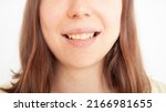 Small photo of person smiles, shows teeth, yellow plaque, crooked teeth, malocclusion. woman shows gums