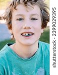 Small photo of Boy getting an orthodontic appliance to correct jaw misalignment.