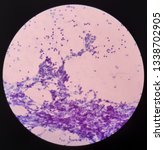 Small photo of Metastatic undifferentiated carcinoma. Note : Looking for nasopharyngeal lesion.