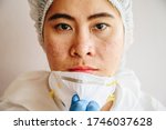 Small photo of Healthcare worker with acne and facial wounds occur from a medical mask after work for a long time in hospital during covid-19 pandemic. Wearing mask for prolonged periods can damage the skin.