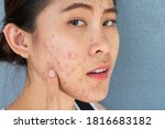 Small photo of Portrait of ugly Asian woman having problems of acne inflammation (Papule and Pustule) on her face. Conceptual of problems on woman skin.