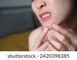 Small photo of Asian woman having pain because of acne occur on her chin. The deeper and larger the pimple, the more painful it can be.