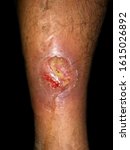 Small photo of Painful carbuncle or large ulcer with surrounding cellulitis or Staphylococcal Streptococcal skin infection in shin in right leg of Asian Burmese male patient. Isolated on black background.