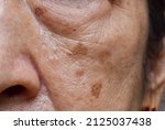 Small brown patches called age spots on face of Asian elder woman. They are also called liver spots, senile lentigo, or sun spots. Closeup view.