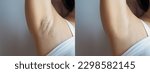 Small photo of Asian woman showing her underarms Before and after pictures of skin care, hair removal on the armpits, underarm chicken skin increase confidence in women