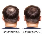 hair loss. Care Concept. transplantation hair. men view from the back, comparison of hair before and after transplantation. bald head.  baldness treatment. medicine. thick healthy hair   head     