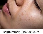 Close-up face women show the freckles, black spots, cheek groove, pimple and uneven skin tone.