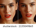 Small photo of close-up girl with hyperhidrosis on her face and excessive oily sheen, with enlarged pores and wrinkles. before and after treatment with botulinum toxin injections and cosmetological therapy