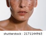 Hyperpigmentation of female skin, close-up of a part of the face on a white background, cosmetology, dermatology, skin care