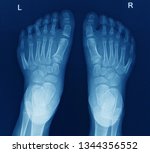 Small photo of an anteroposterior x-ray or radiograph of both feet showing abnormal sixth toe on both side of foot. this congenital defect is called polydactyly.