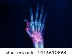 A hand and wrist x-ray showing severe arthritis of the wrist or carpus and Boutonniere deformity of the thumb. The patient has advanced rheumatoid arthritis. Dark background.
