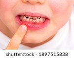 Small photo of Child loose tooth. Little boy 6 years old loose baby tooth incisor. Kids dental medicine and oral hygiene concept. Emotions of child. Close up portrait