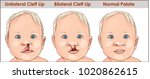 illustration of a cleft palate... | Shutterstock .eps vector #1020862615
