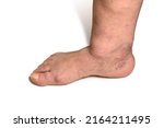 Small photo of Swelling female leg with inflammation in diabetic nephropathy and varicose veins. Elderly woman's leg with hematoma and edema on white background. Closeup