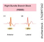 right bundle branch block rbbb  ... | Shutterstock .eps vector #1762897262