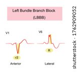 left bundle branch block  lbbb  ... | Shutterstock .eps vector #1762909052