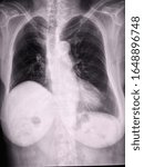 Small photo of Chest X-ray image lungs evidence of post RUL lobectomy with compensatory hyperinflation of the remaining lobes and elevated right hemidiaphragm. Cardiomegaly with atherosclerotic change of aorta.